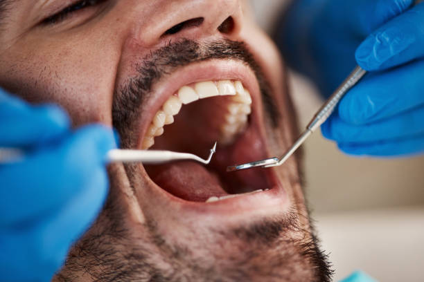 Dental Bonding in Batesville, IN